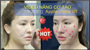 VIDEO NÂNG CƠ TÁO Apple cheek lift – 苹果肌提拉