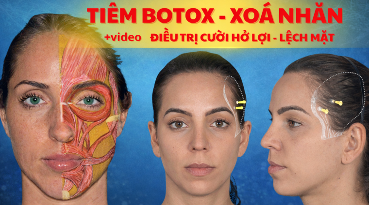 b botox