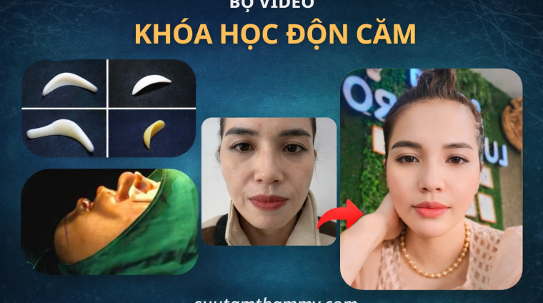 b độn cằm