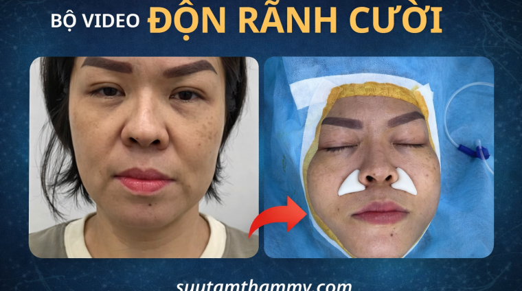 b độn rãnh cười