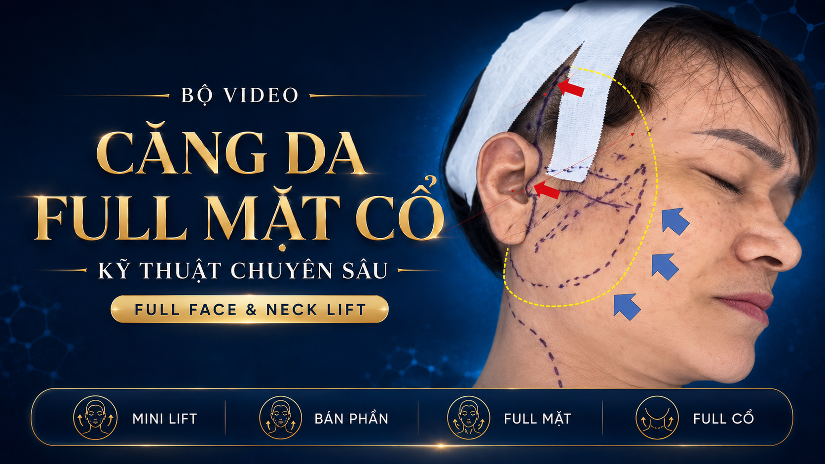 VIDEO CĂNG DA BÁN PHẦN & CĂNG DA TOÀN MẶT – CỔ NÂNG CAO