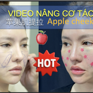 VIDEO NÂNG CƠ TÁO Apple cheek lift - 苹果肌提拉